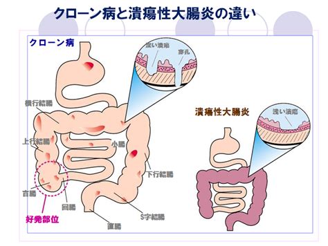 腸胃影響皮膚|皮膚の炎症が腸炎の悪化を招く「皮膚－腸相関」のメカニズムを。